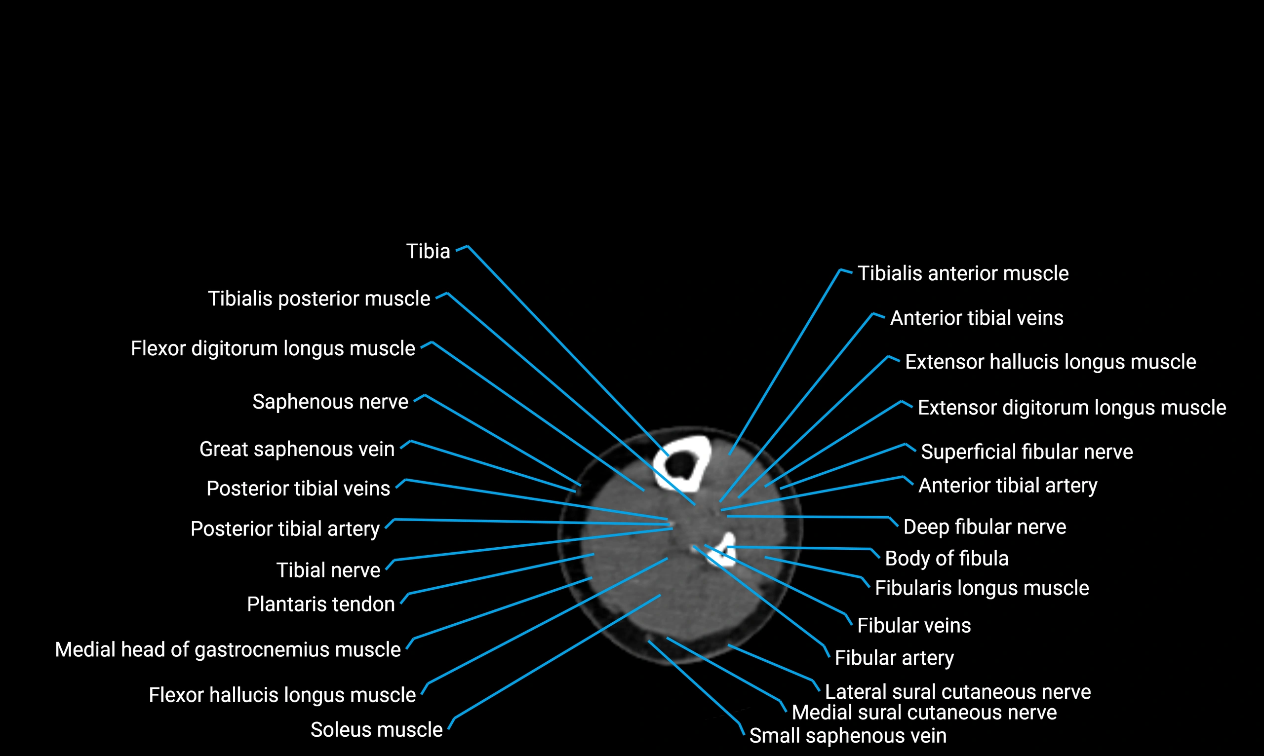 CT lower limb axial cross sectional anatomy labelled image 122 (2).webp
